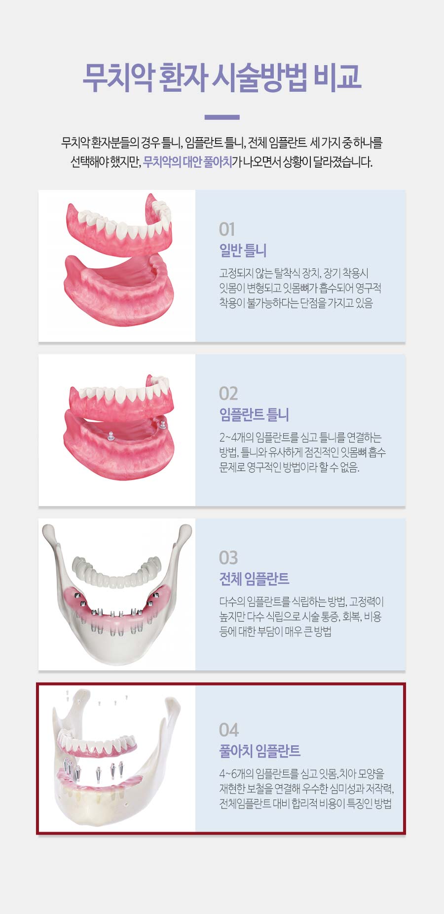 이천 서울이엘치과 풀아치 임플란트 안내 이미지 5