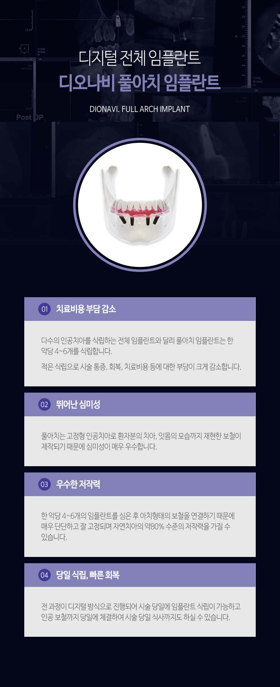이천 서울이엘치과 풀아치 임플란트 안내 이미지 6