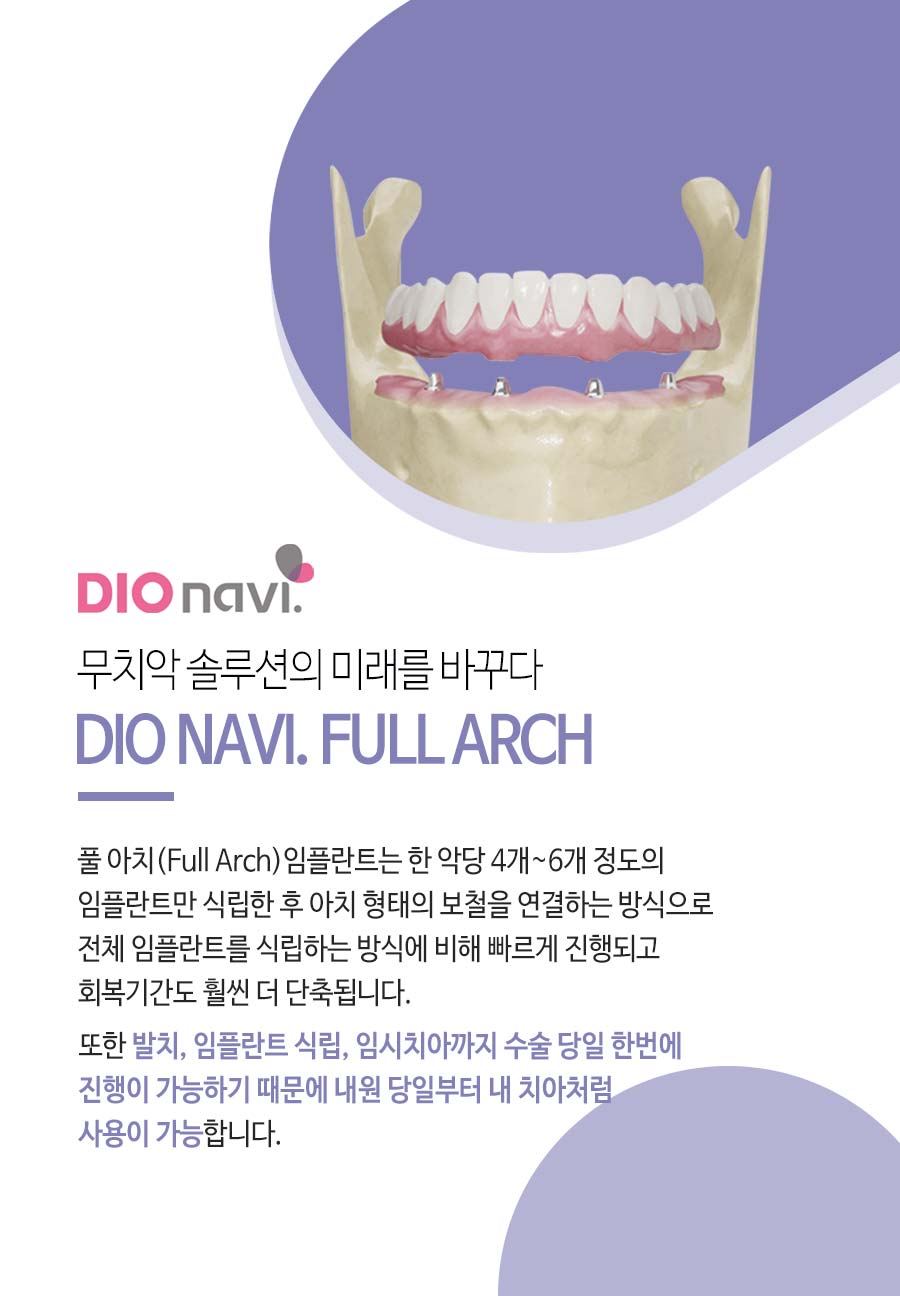이천 서울이엘치과 풀아치 임플란트 안내 이미지 8