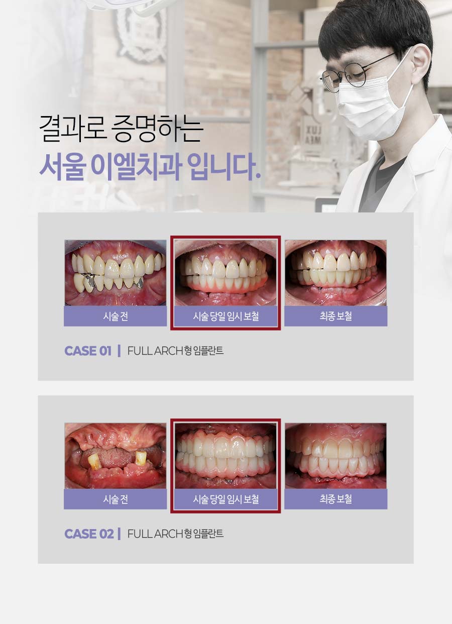 이천 서울이엘치과 풀아치 임플란트 안내 이미지 13