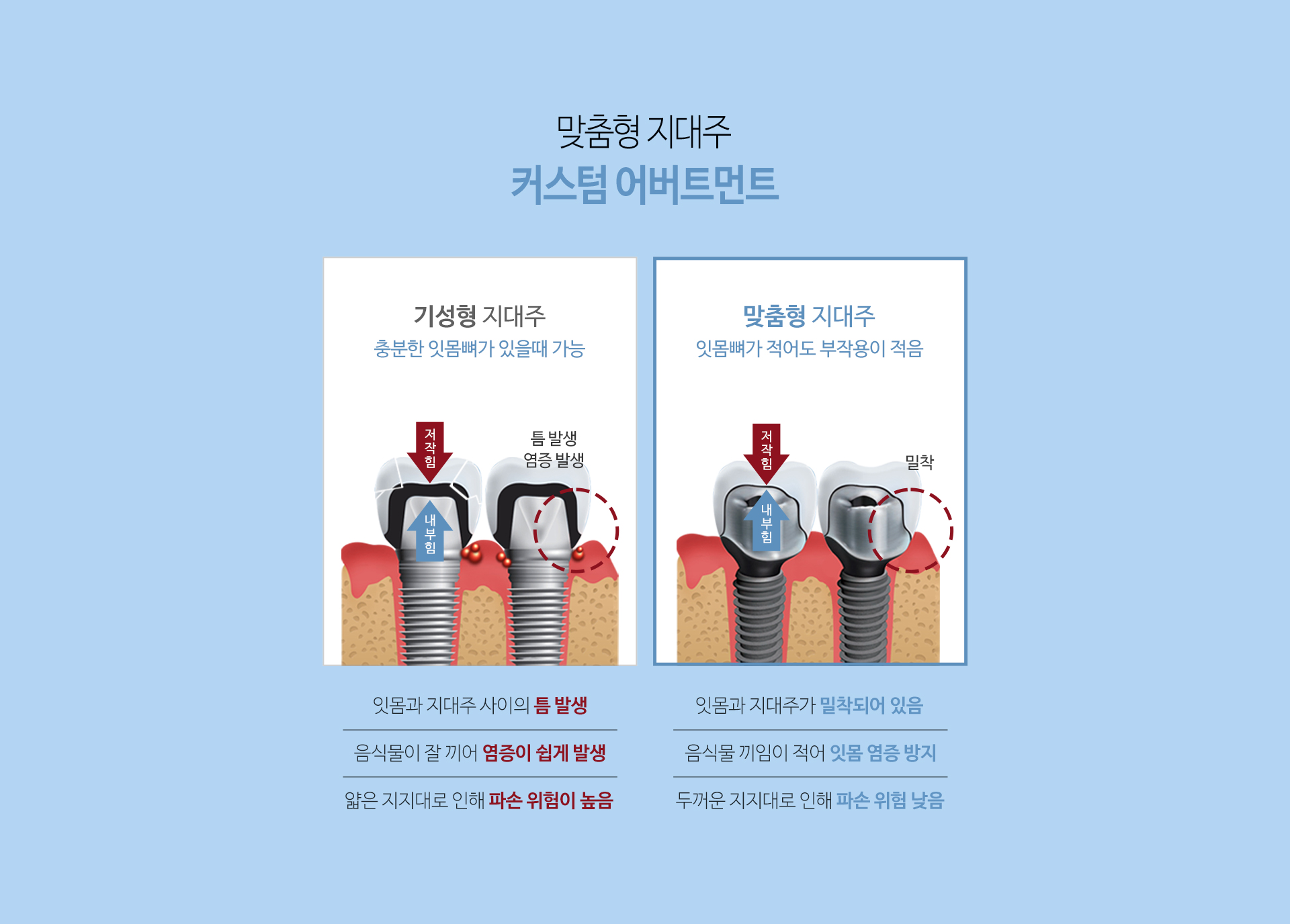 이천 서울이엘치과 디지털 임플란트 안내 이미지 14