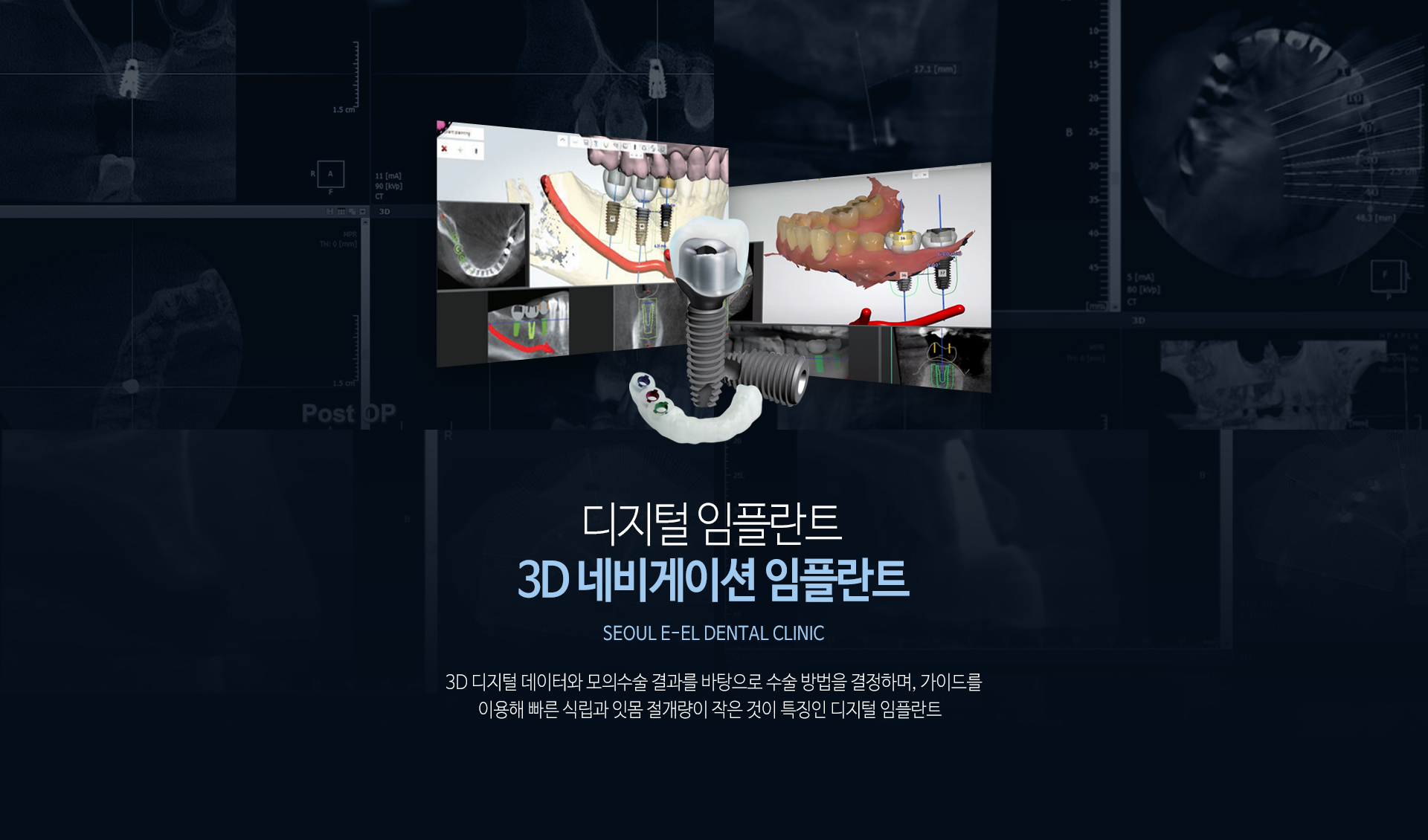 이천 서울이엘치과 디지털 임플란트 안내 이미지 3