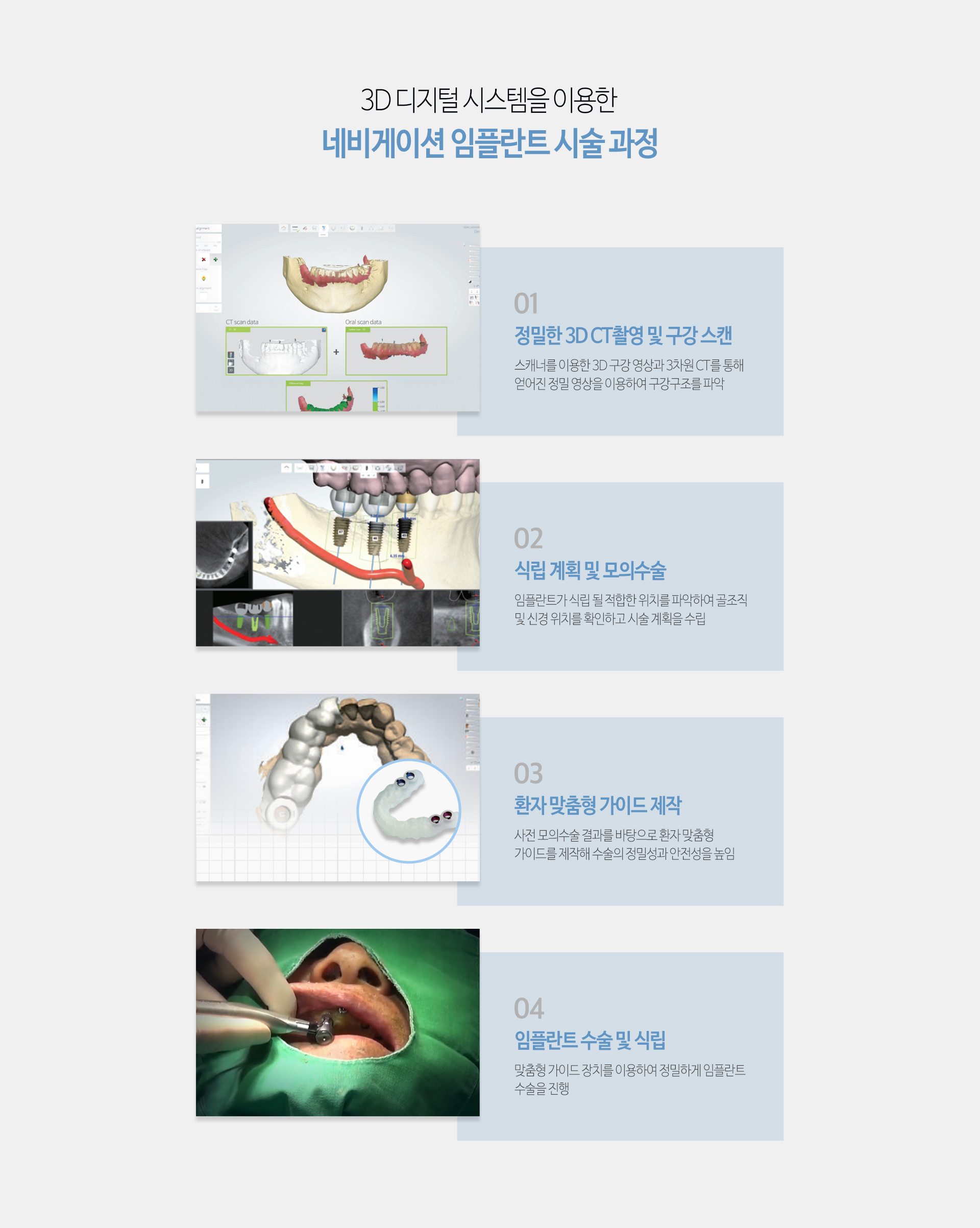 이천 서울이엘치과 디지털 임플란트 안내 이미지 6