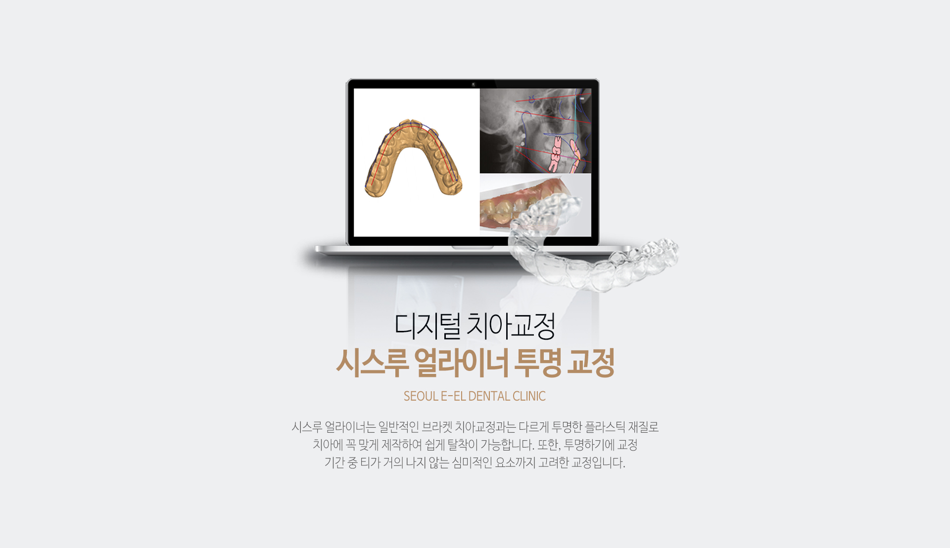 이천 서울이엘치과 디지털 치아교정 안내 이미지 2