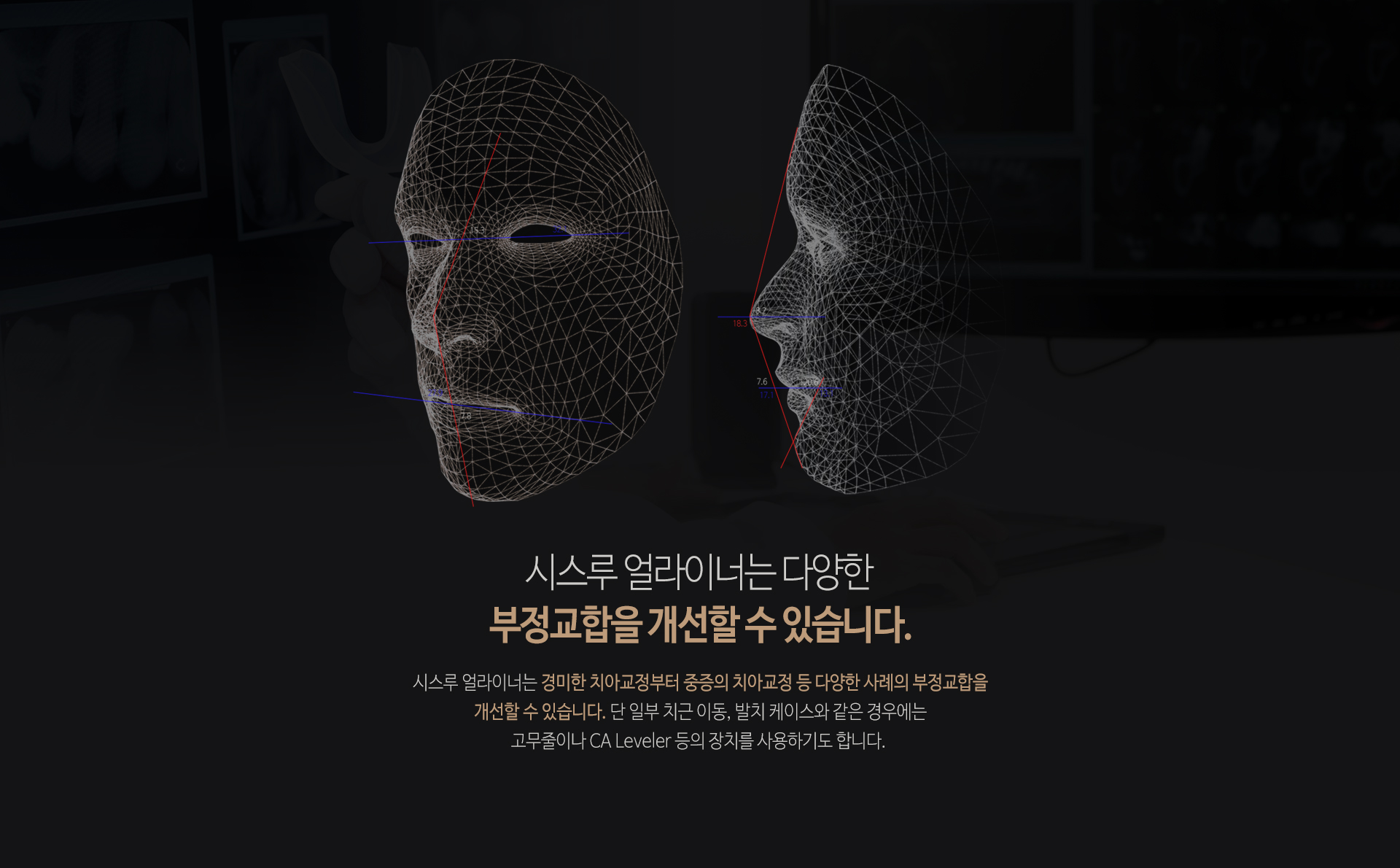 이천 서울이엘치과 디지털 치아교정 안내 이미지 7