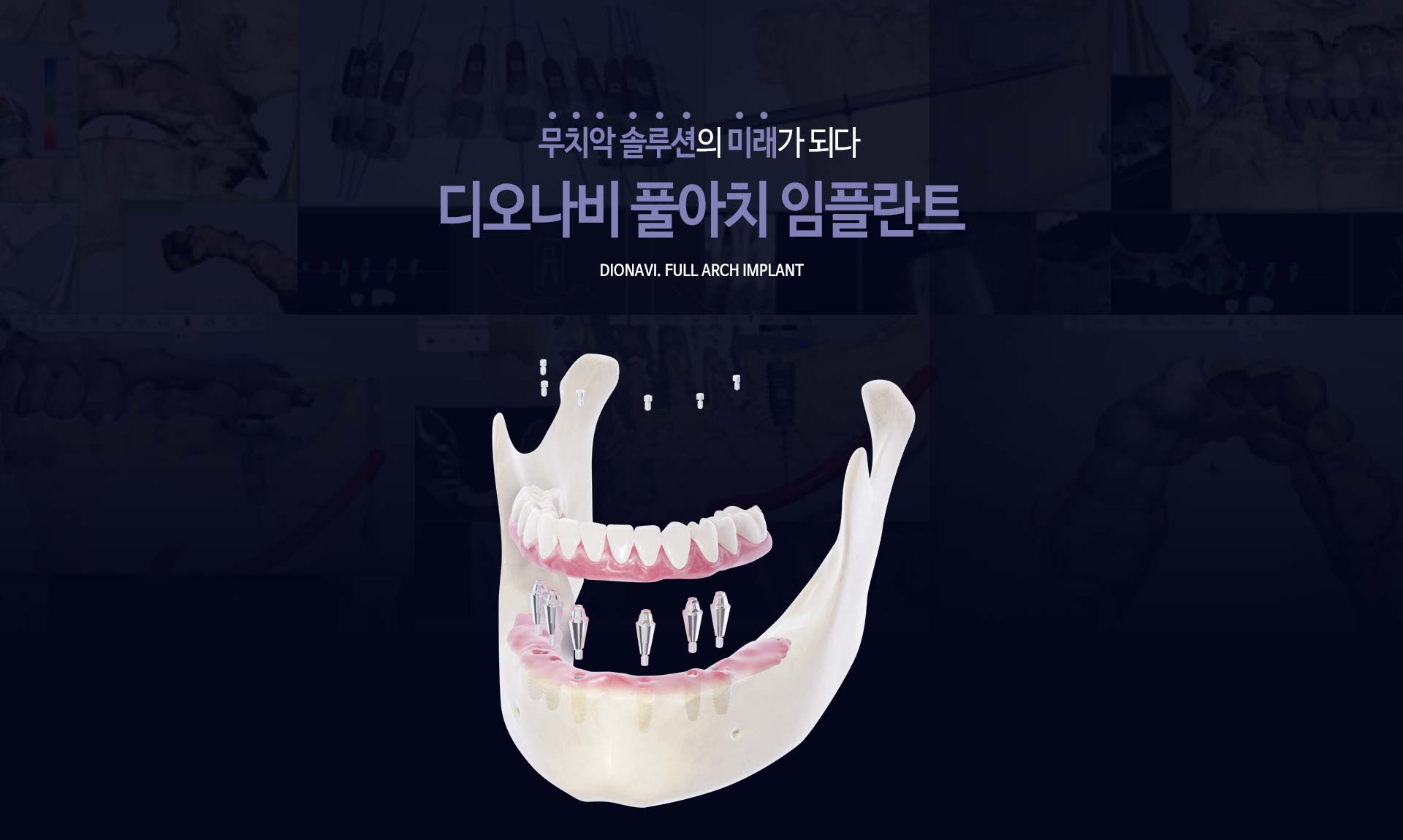 이천 서울이엘치과 풀아치 임플란트 안내 이미지 1