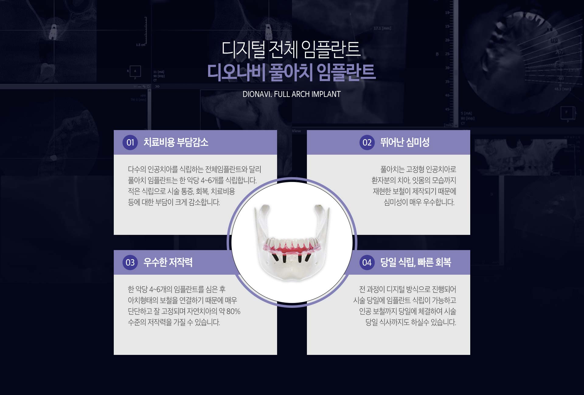 이천 서울이엘치과 풀아치 임플란트 안내 이미지 6