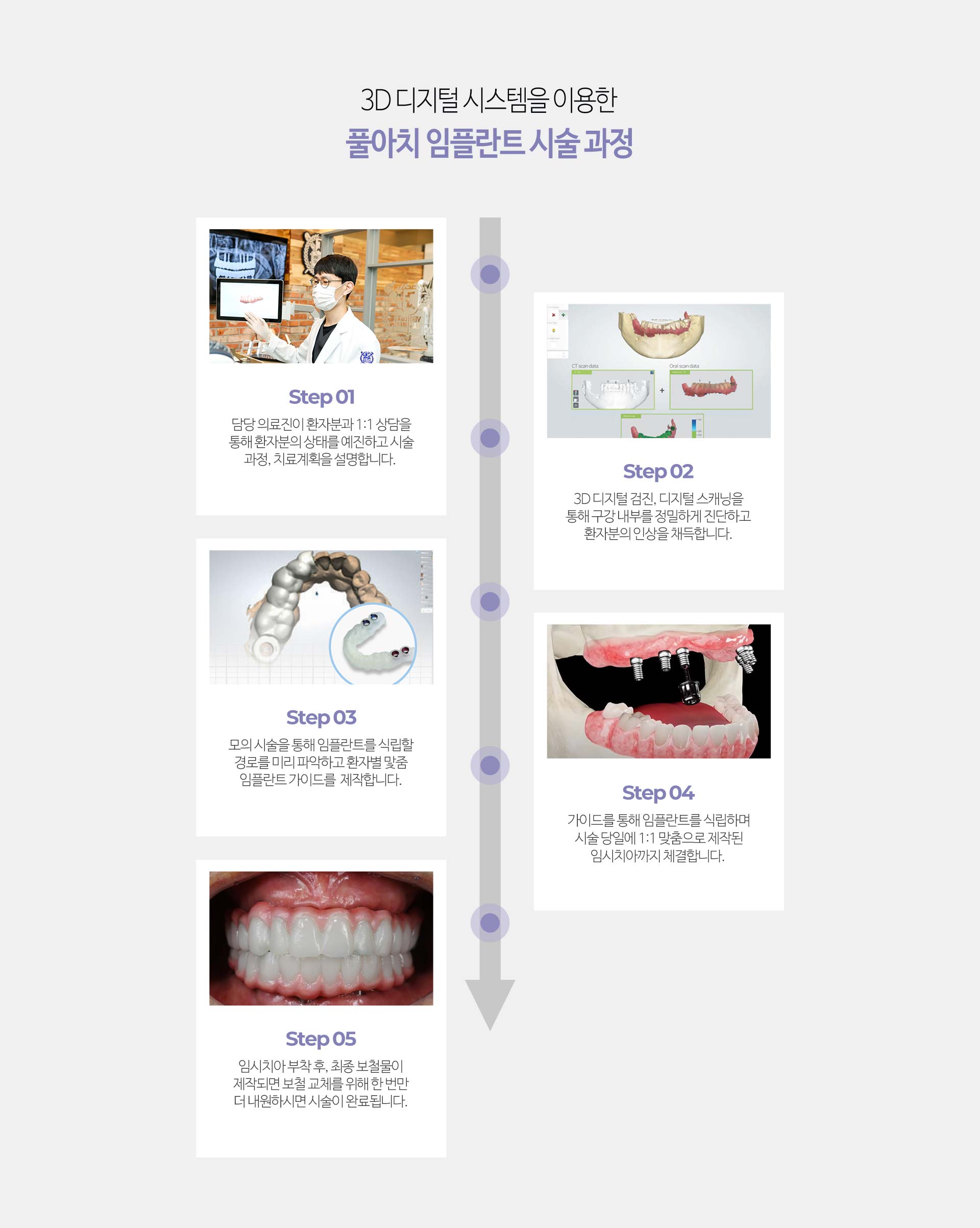 이천 서울이엘치과 풀아치 임플란트 안내 이미지 7