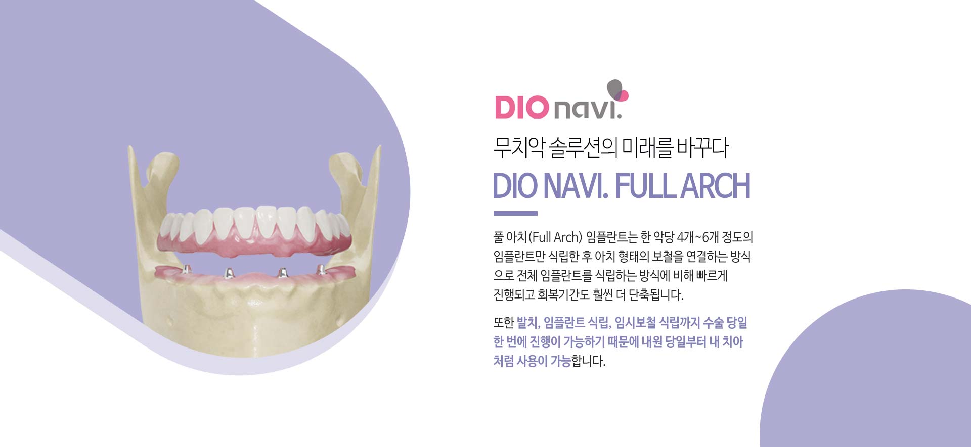 이천 서울이엘치과 풀아치 임플란트 안내 이미지 8